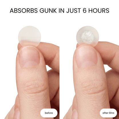 Hydrocolloid Pimple Patches